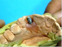 /album/galeria-de-fotos-carga-imediata-apos-exodontia-atraumatica-/carga-imediata-com-exodontia-atraumatica15-jpg/